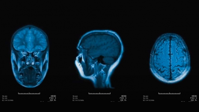 Nueva prueba para detectar el alzhéimer en una fase temprana 